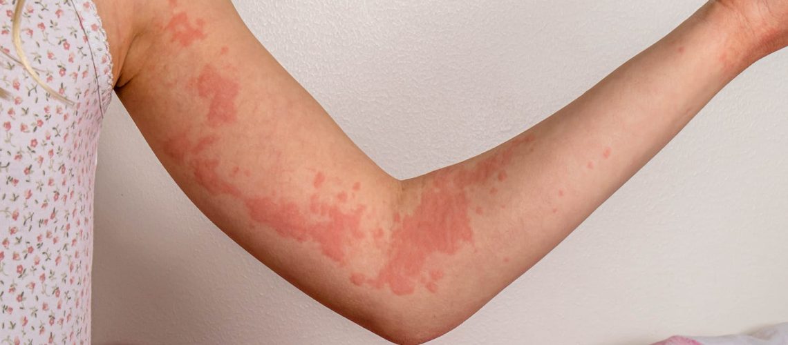 Peut-on faire une crise d'urticaire à cause du stress ?